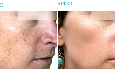 Skin Resurfacing Treatments