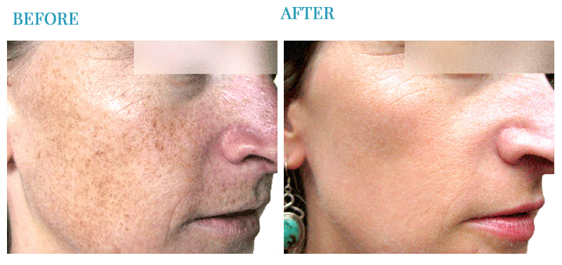 laser skin treatment