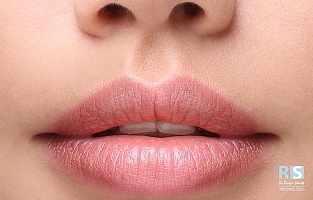 Lip-Enhancement-Rejuvenation