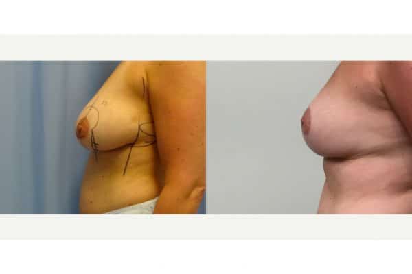 Breast Lift & Breast Reduction