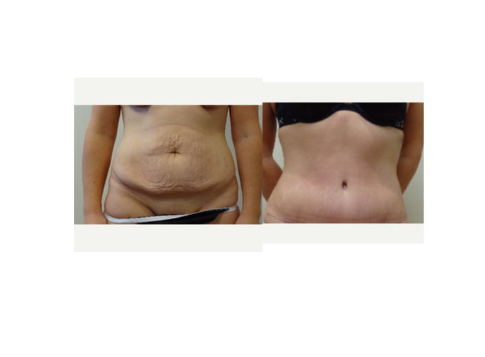 tummy tuck