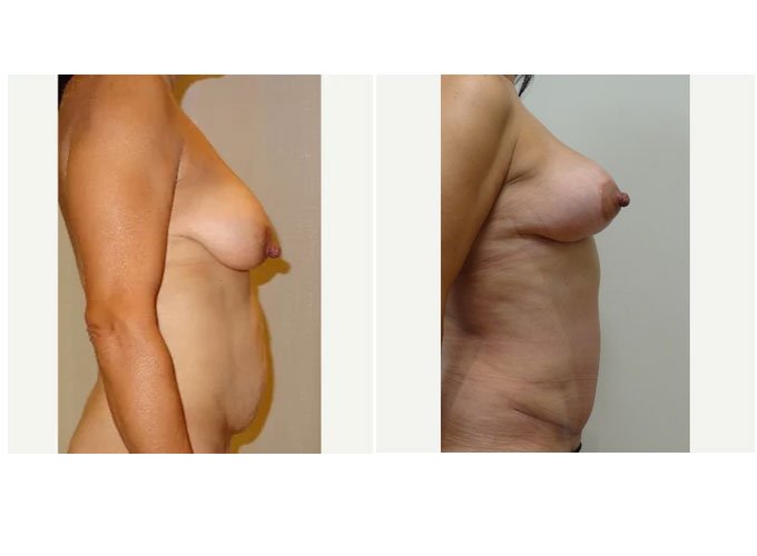tummy tuck, mommy makeover surgery