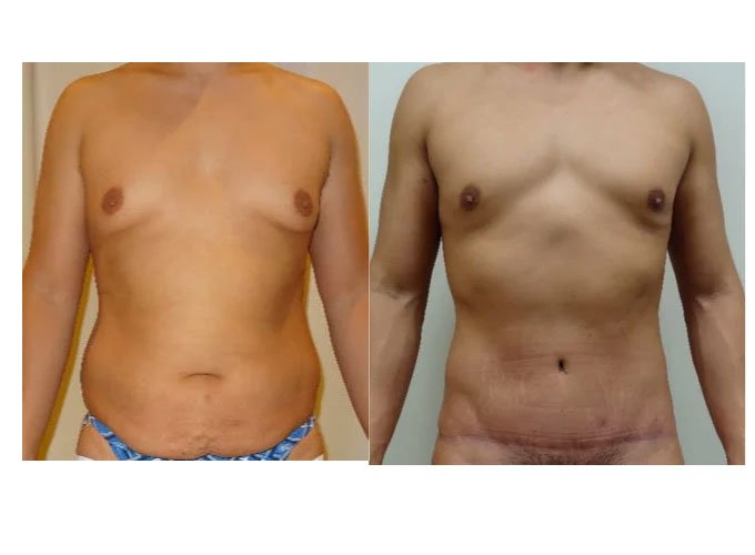 tummy tuck with gynecomastia and liposuction
