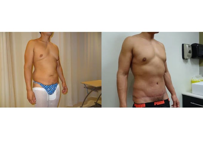 Male Breast Reduction surgery