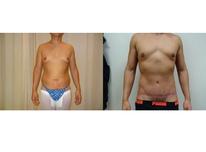 Liposuction procedure