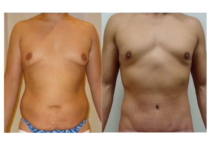 Male Breast Reduction surgery