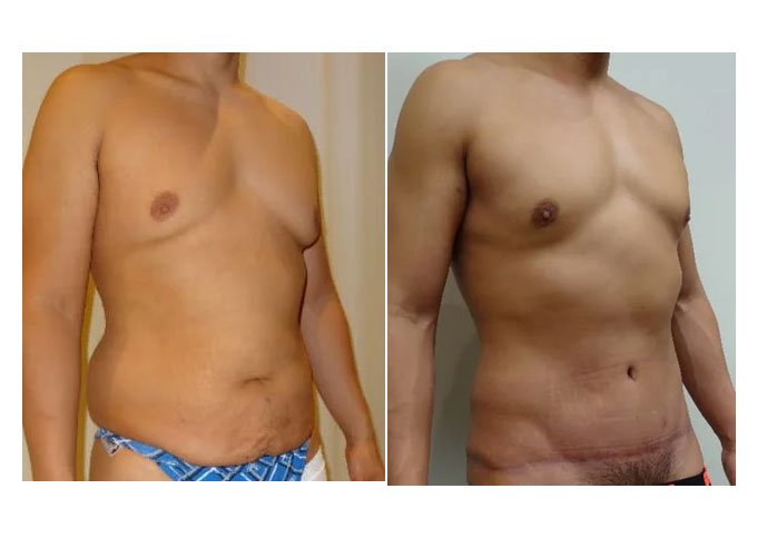 tummy tuck surgery