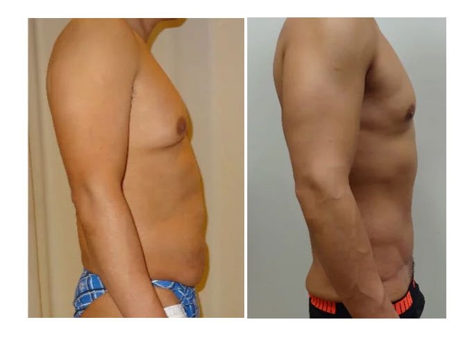 Tummy Tuck procedure