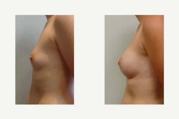 Breast Implants