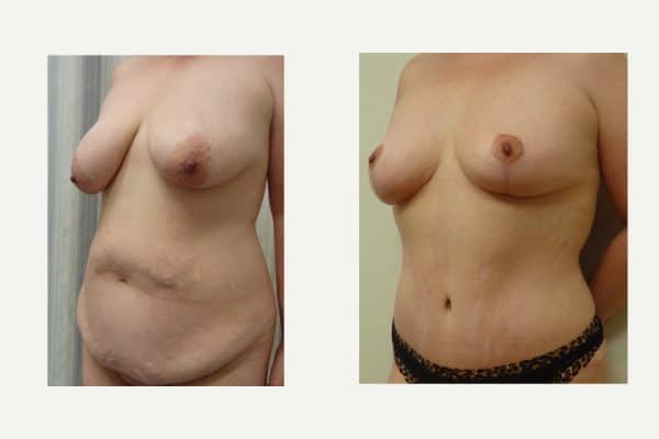 Mommy Makeover, Tummy Tuck, Breast Reduction