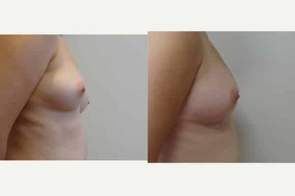 Breast Fat Transfer