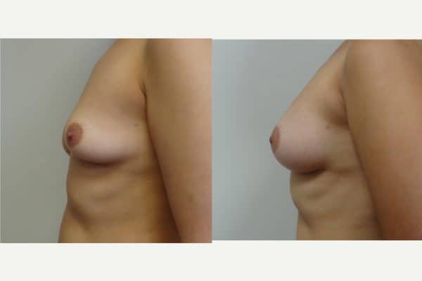 Breast Implants, Breast Augmentation