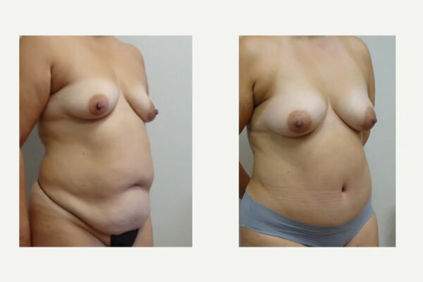 Tummy Tuck