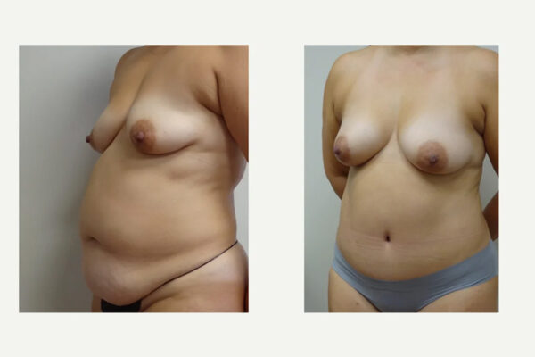Tummy Tuck