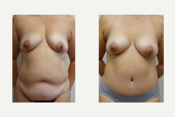 Tummy Tuck